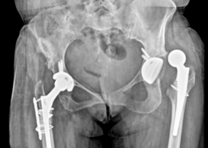 Total Hip replacement surgery