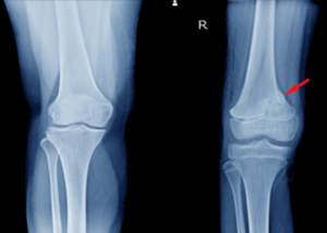 Total Knee replacement surgery