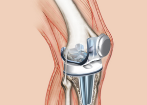 Revision of Total Knee Replacement