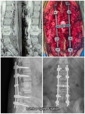 Lumbar Spine Surgery with Implant Fixation | Dr. Rahul Sharma