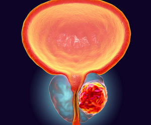 Bladder Cancer