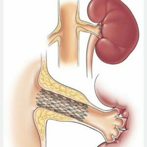 Renal Artery Stenting
