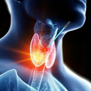 Thyroid Nodule Ablation