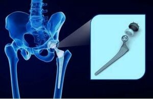 Total Hip Replacement (THR)