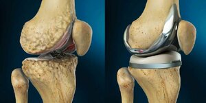 Total Knee Replacement (TKR)