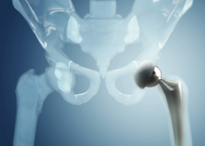 Hip Arthroscopy Surgery