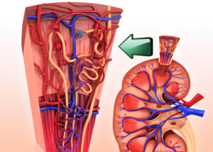 Renal Artery Stenting