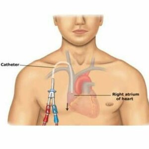 Permacath Insertion for Dialysis