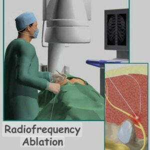 Radiofrequency Ablation