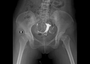 Hysterosalpingography(HSG)