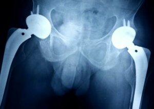 Hip Replacement