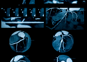 Coronary Angiography