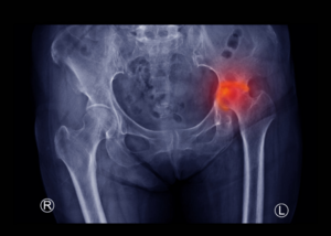 Avascular Necrosis (AVN) and Joint Preservation Guide by Dr. Prasoon Shamshery
