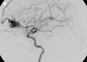 Arteriovenous Malformation (AVM) Surgery
