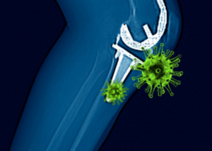 Prosthetic Joint Infections