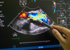 Doppler Ultrasound USG