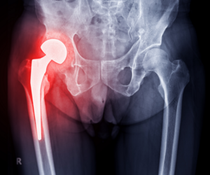 Revision Hip Replacement