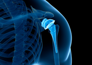 Shoulder Replacement Surgery