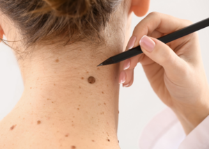 Mole, Wart, and Skin Tag Removal