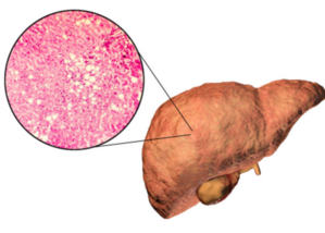 Non-Alcoholic Fatty Liver Disease | | Dr. Abhijeet Karad