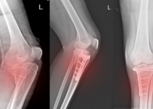 Fracture Management (Adult and Children)