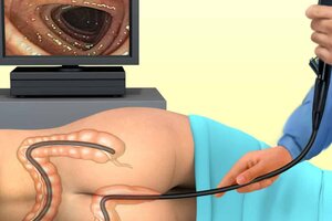 Colonoscopy
