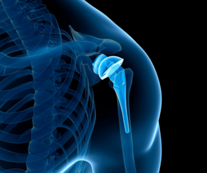 Shoulder Replacement Surgery