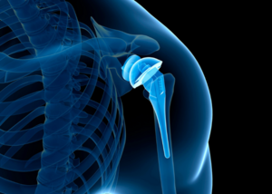 Shoulder Replacement Surgery