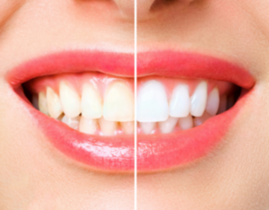 Teeth Whitening