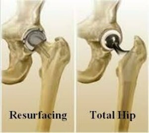 resurfacing total hip replacement