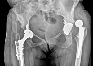 Pelvi Acetabular Surgery