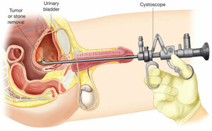 Diagnosis Cystoscopy and Biopsy