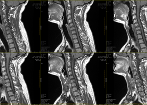 Radiculopathy Treatment