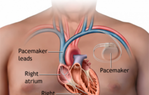 Pacemaker Implantation
