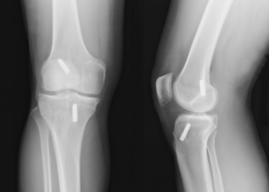 Arthroscopic ACL reconstruction