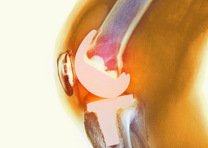 Revision Joint Replacement