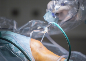 Arthroscopic Meniscus repair/balancing