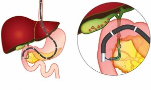 ERCP (Endoscopic Retrograde Cholangiography)