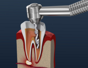 Root Canal Therapy