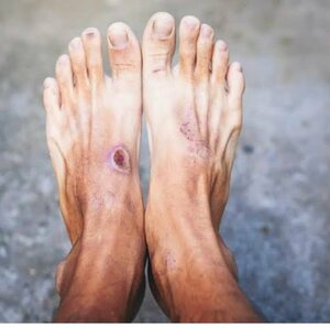 Diabetic Foot Management