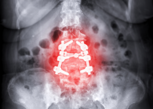 Laminectomy &amp; Decompression for Spinal Stenosis