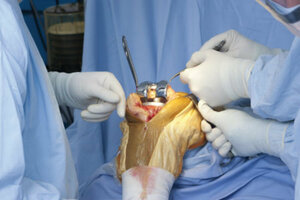Robotic Knee Replacement