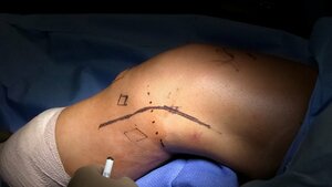 Meniscus Repairs/ACL/PCL/MCL/PLC reconstruction