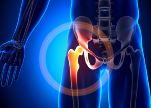 Hip Replacement