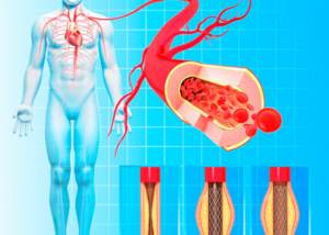 Peripheral Angioplasty