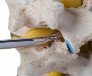 Icon of Spine Endoscopy Services, Matruchhaya Spine Clinic