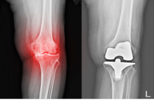 Cartilage Regeneration