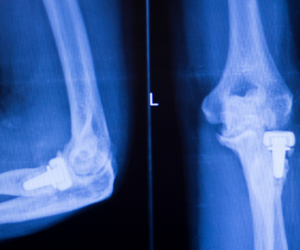 Elbow Replacement Surgery