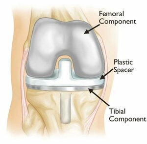 Primary &amp; Revision Total Knee Replacement