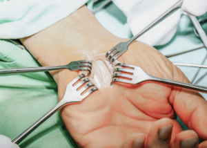 Carpal Tunnel Syndrome Surgery